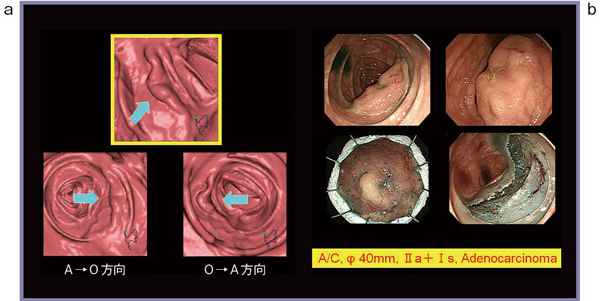 図3　症例3　 a：大腸CTの内腔像　b：内視鏡像