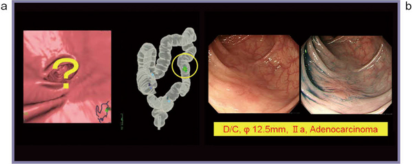 図4　症例4 a：大腸CT　b：内視鏡像