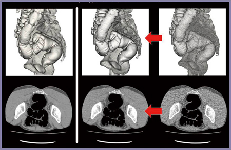 図5　AIDR 3Dによるノイズ低減（VR画像） SD30/DLP＝38.5mGy・cm/0.58mSv