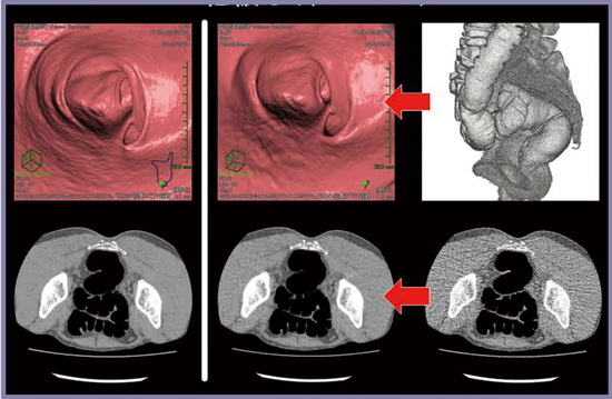 図6　AIDR 3Dによるノイズ低減（内腔像） SD30/DLP＝38.5mGy・cm/0.58mSv