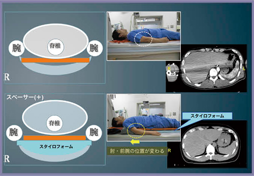 図5　バックボードのスペーサーによる上肢ポジショニング
