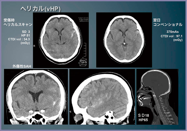 図7　症例2：頭頸部CT（P）＋体部造影Panscan（vHP）
