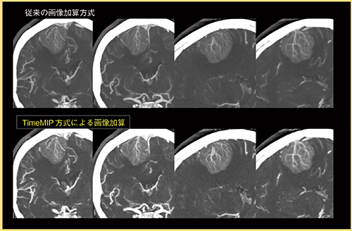 図3　症例3：髄膜腫のTime MIP像 微細な血管描出能を向上