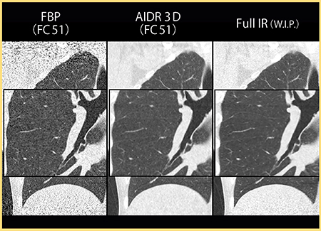 図4　肺野画像（0.27mSv） 120kV，5mAs，2mm