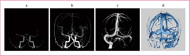 図6　症例2の4D-CTA a，b：動脈相 c：静脈相 d：静脈相のVR画像