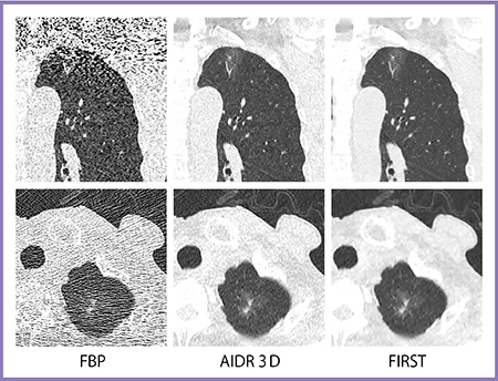 図6　肺がん検診用超低線量胸部CT（0.2mSv）