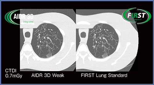 図3　低線量肺がんCTにおけるAIDR 3DとFIRSTの比較