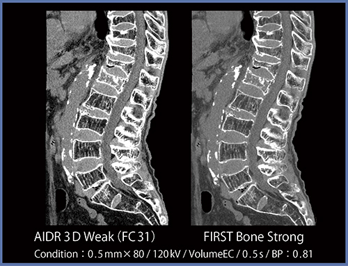 図1　症例1：腰椎骨折（どちらもWW，WLは同じ。図2〜11も同様）