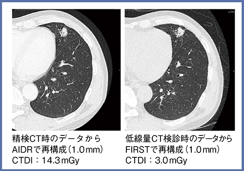 図6　症例5：肺腺癌stage1A（60歳代，男性）