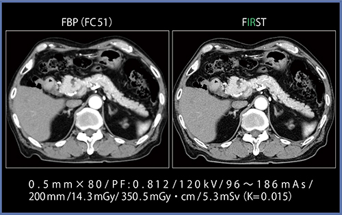 図4　FBPとFIRSTの低コントラスト検出能の比較（画像ご提供：藤田保健衛生大学様）