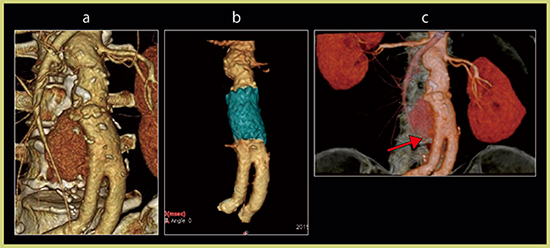 図5　人工血管置換術後のleak a：CTA VR画像　b：DV-CTA画像で描出されたカフの破損によるleak c：DV-CTA画像で描出されたYグラフト2か所のleak