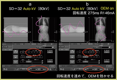 図1　症例1：Sure kVとOEMの設定画面 Auto kVや回転速度の変更で，Volume ECを適用した撮影が可能になる。