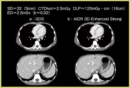 図2　症例1：小児体幹部の造影CT a：QDS　b：AIDR 3D Enhanced Strong