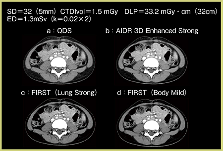 図4　症例3：小児体幹部へのFIRSTの適用 a：QDS　b：AIDR 3D Enhanced Strong　c：FIRST（Lung Strong）　d：FIRST（Body Mild）
