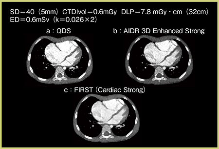 図5　症例4：小児循環器へのFIRSTの適用 a：QDS　b：AIDR 3D Enhanced Strong　c：FIRST（Cardiac Strong）