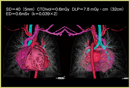図6　図5 cのFIRST（Cardiac Strong）のデータから作成した3D再構成画像