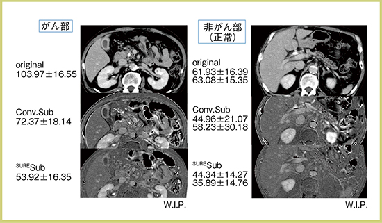 図3　膵頭鉤部がん＋閉塞性膵炎改善後の症例に対する従来法とSURESubtraction Iodine Mappingの比較