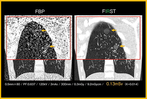 図4　胸部ファントムでのFIRSTとFBP法の比較