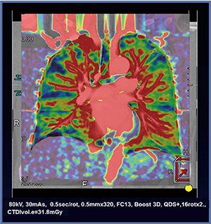 図2　全肺Dynamic CE-perfusion ADCT