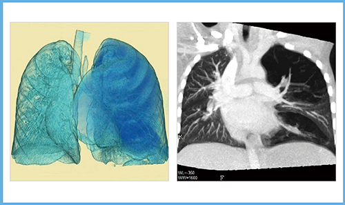 図4　ADCTの呼吸下ダイナミック撮影による小児スワイヤージェームズ症候群の画像