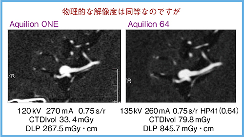 図5　ADCT vs. MSCT：脳動脈瘤のMPR画像