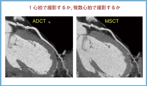 図6　ADCT vs. MSCT：冠動脈CTA画像