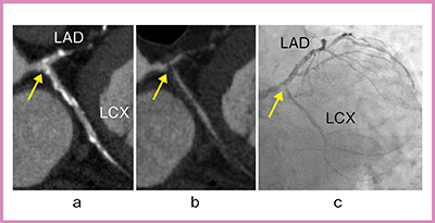 図2　症例1：石灰化症例 a：造影CT画像　b：冠動脈サブトラクションCT画像　c：CAG