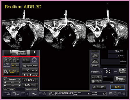 図5　肺生検における3断面透視画面