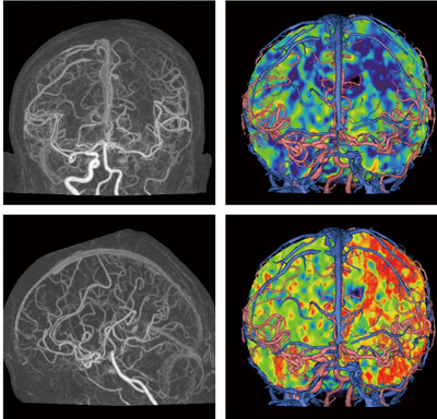 図3　頭部perfusion CT画像（AIDR 3D 使用症例）