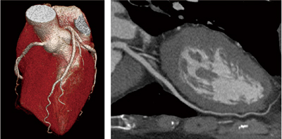 図5　71bpmの心臓1心拍撮影 臨床画像例（ViSION Edition 0.275秒回転にて） （データご提供：藤田保健衛生大学病院様）