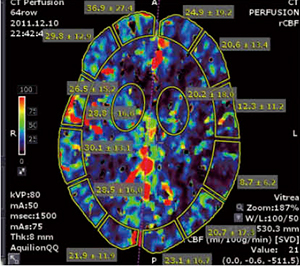 図5　4D脳血流解析（ROIテンプレートの一例）