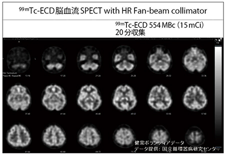 図3　高分解能ファンビームコリメータを使って撮像した頭部SPECT画像（画像ご提供：国立循環器病研究センター様）