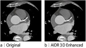 図4　AIDR 3D Enhanced：臨床画像