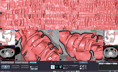図2　Vitrea大腸解析ソフトウェア（VGP画面）