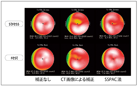 図6　SPECT/CT装置のCT画像を使った減弱補正とSSPAC法による減弱補正の比較