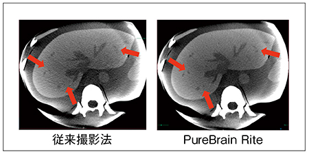 図2　LCIにおけるX線制御の違い PureBrain Riteではノイズが減少し，➡部分で視認性が向上している。