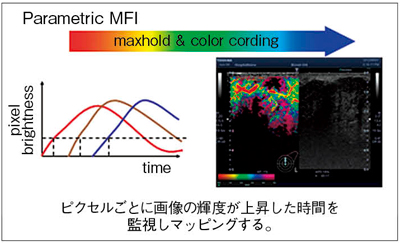 図3　Parametric MFI機能 速く染まった部位は赤く，遅く染まった部位は紫で表示されている。（画像ご提供：りんくう総合医療センター・位藤俊一先生）