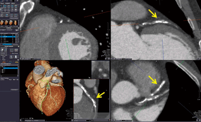 図2　CT Cardiac Coronary Analysis解析例（図1と同症例）