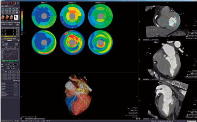図3　CT Cardiac Functional Analysis解析例