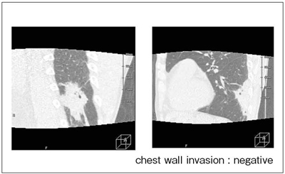 図2　ダイナミックスキャンによる肺がんの動態観察