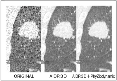 図5　AIDR 3DとPhyZiodynamicsによるノイズリダクション効果の比較