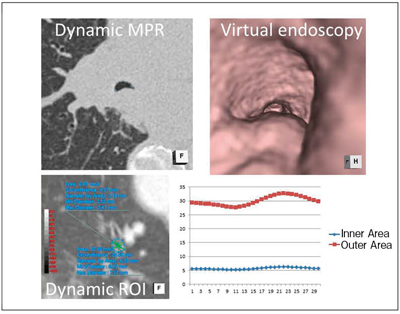 図7　Dynamic MPRとVirtual endoscopy