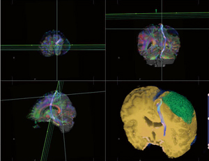 脳神経外科でのMRトラクトグラフィーによる手術シミュレーション