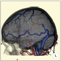 図1　動脈・静脈・脳表画像・骨画像の加算表示