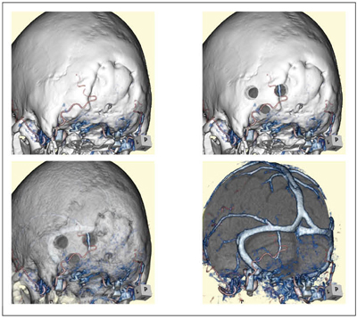 図2　聴神経腫瘍等で行われる後頭下開頭法での作成例