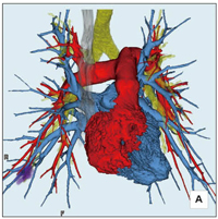 図5　肺動静脈分離画像