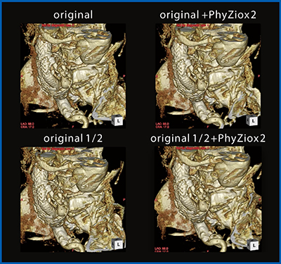図7　同症例の元画像とPhyZiodynamicsによる補完処理画像の比較