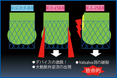 図5　TAVR/TAVIにおける大動脈とデバイスのサイズのイメージ