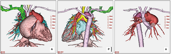 大動脈離断症の3D再構成画像心臓、大動脈、肺動静脈を色分けして術前のシミュレーション情報を提供。同症例の手術に人工血管ではなく患者自身の血管を使ったのは世界初。