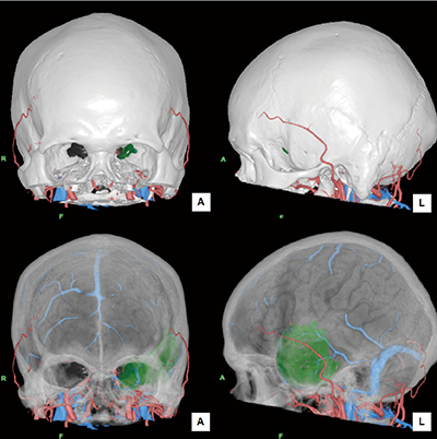 図3　骨・脳表のFusion画像